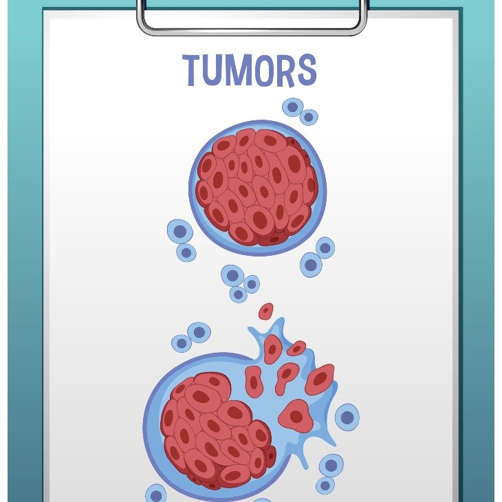 Gambar: Cara Mencegah Tumor: Tips Efektif untuk Kesehatan yang Optimal