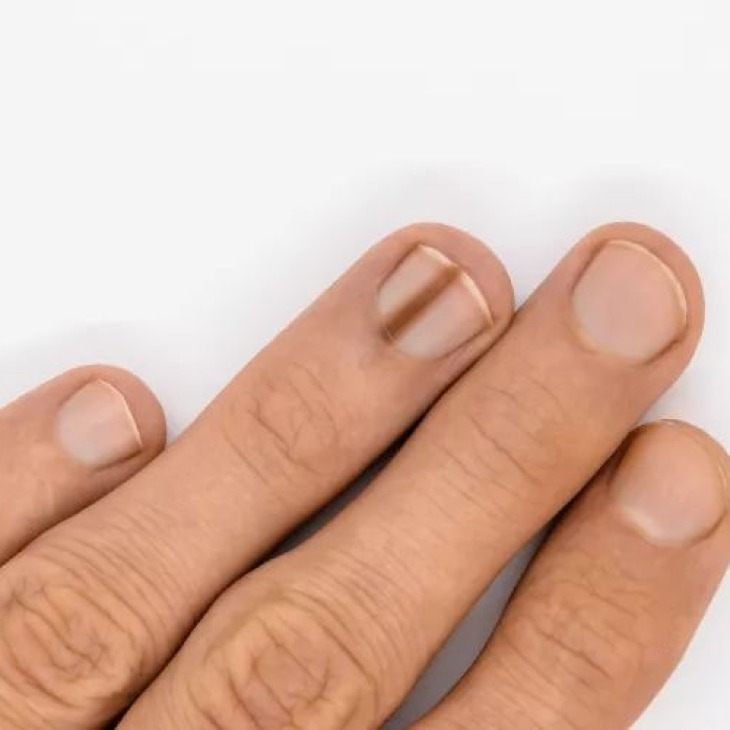 Garis Hitam di Kuku, Benarkah Bisa Menjadi Tanda Kanker?