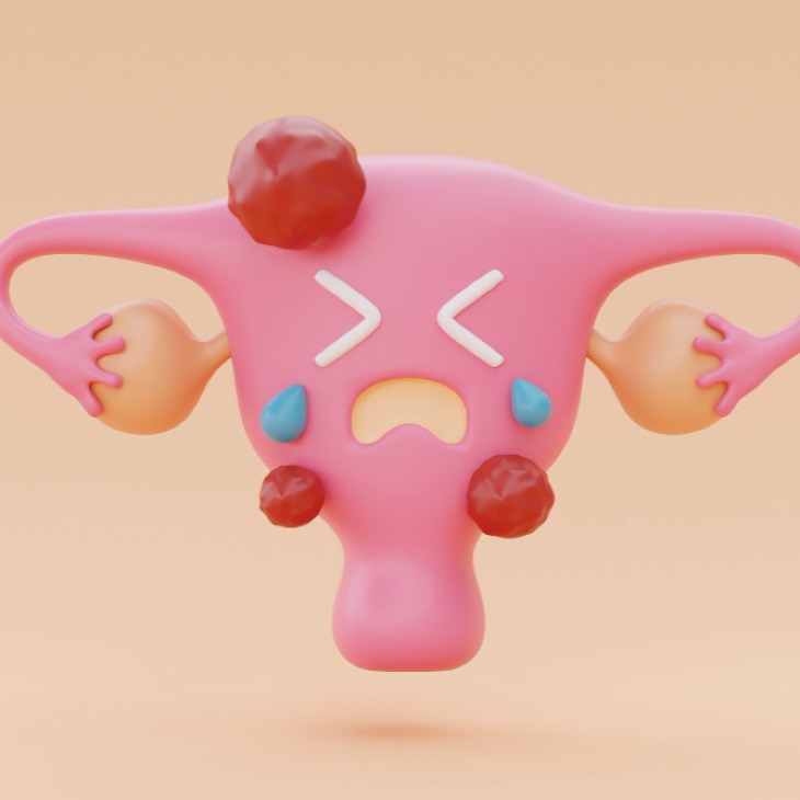 Cara Alami Mengecilkan Miom Tanpa Efek Samping